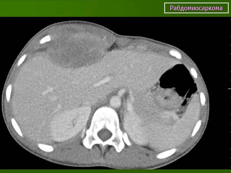 Рабдомиосаркома мягких тканей на узи фото Онкология. Саркома. Рабдомиосаркома. + Портал радиологов