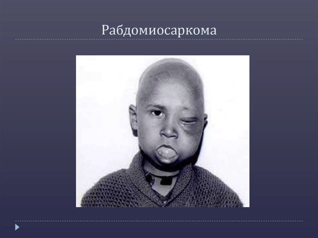 Рабдомиосаркома мягких тканей на узи фото Рак у детей и подростков ОК ДОК Дзен