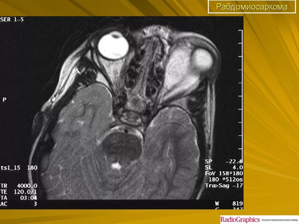 Рабдомиосаркома мягких тканей на узи фото Орбитальная патология. Онк. Рабдомиосаркома. Орбитальная нейрофиброма. + Портал 