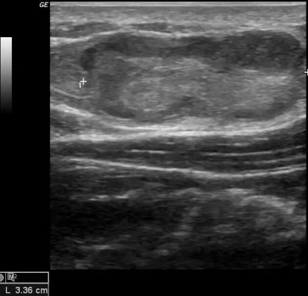 Рабдомиосаркома мягких тканей на узи фото Liposarcoma A lesion pointed by patient is somewhat elliptical well-defined lesi