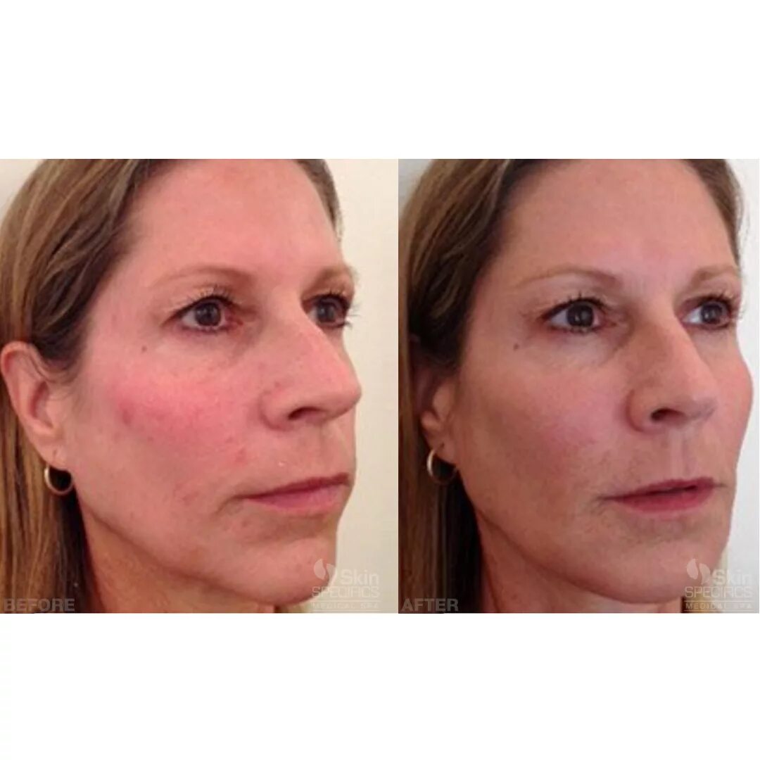 Радиесс для лица до и после фото Medical Spa West LA & La Cañada Flintridge Skin Specifics mid face and cheek enh