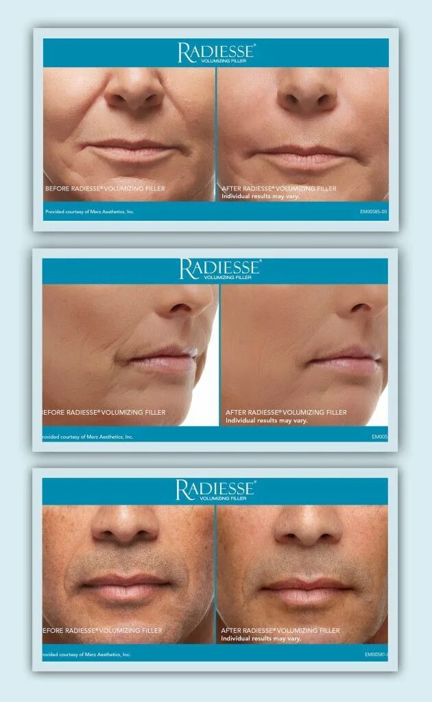 Радиесс фото до и после цена RADIESSE This semi-permanent injectable adds volume to faces and fills in wrinkl