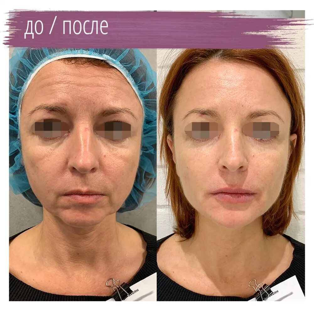 Radiesse in New Jersey SOMA Skin & Laser