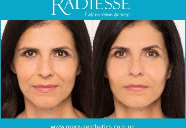 Радиесс отзывы фото до и после We return youth: Radiesse will stop the ptosis of the soft tissues of the face -