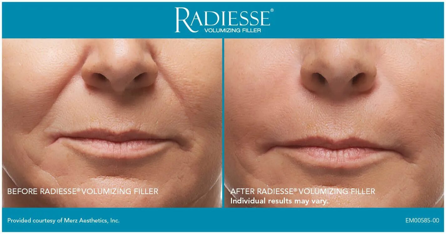 Радиесс отзывы фото до и после Radiesse helps fill deep wrinkles and can last almost a year. At avecinia, Radie