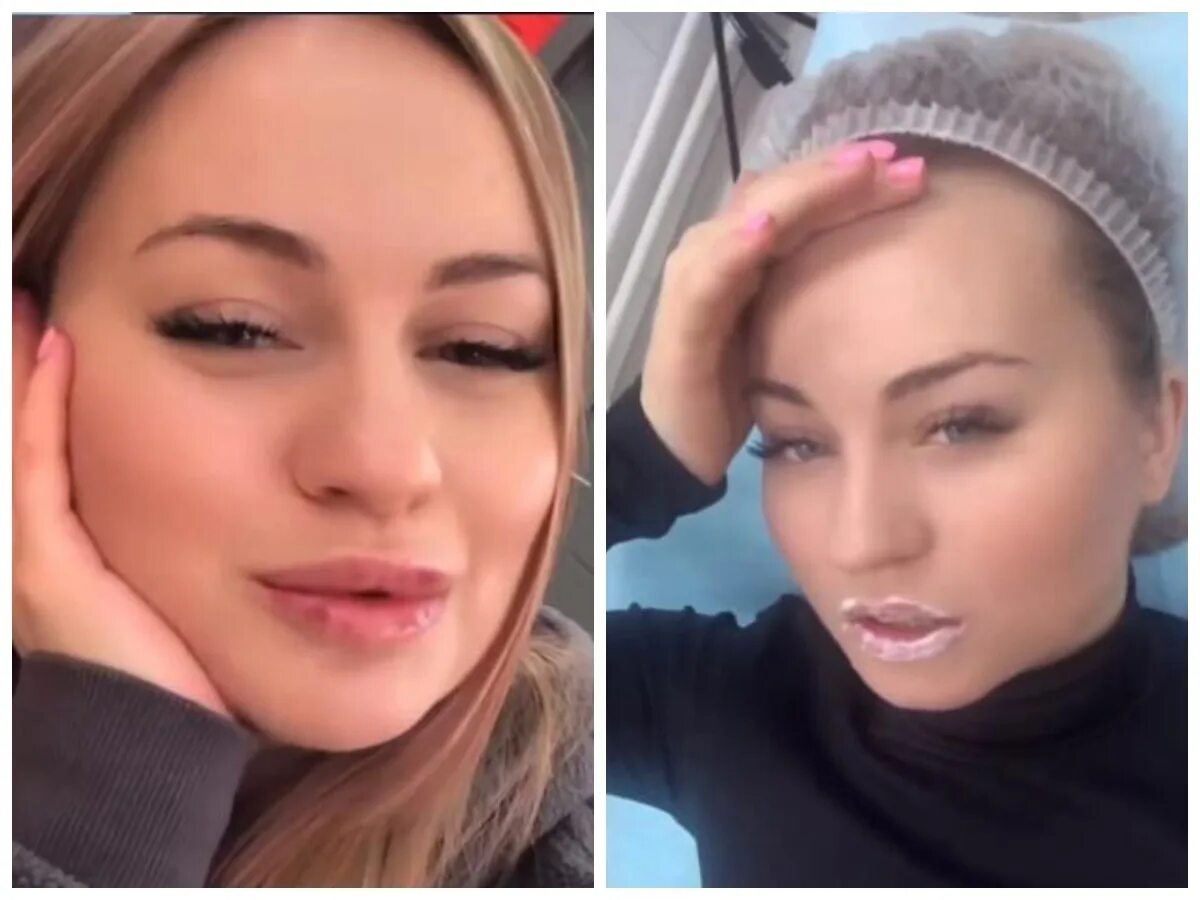 Рахимова элина до и после пластики фото Elina Rakhimova broke up to a free cosmetologist and increased her lips Elina Ra