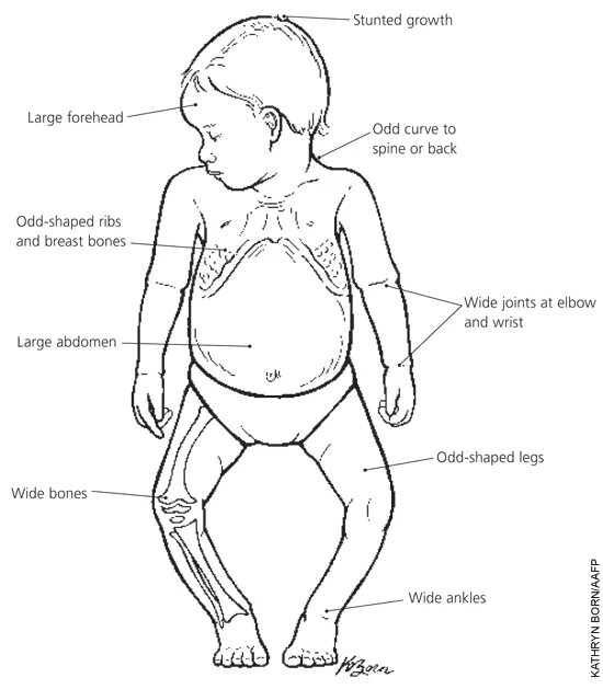 Рахит симптомы и лечение фото Rickets: What It Is and How It’s Treated AAFP