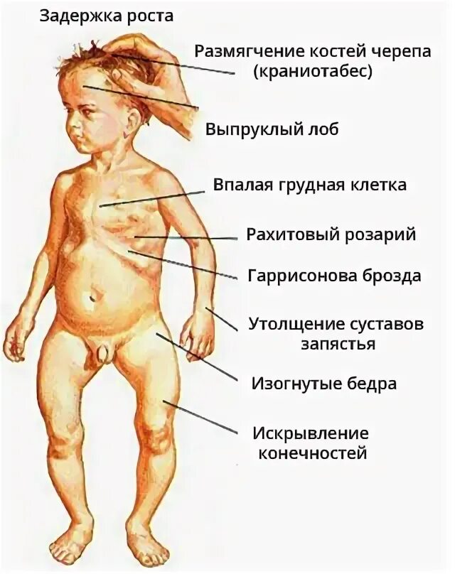 Рахит у детей симптомы до года фото Признаки рахита у грудничков