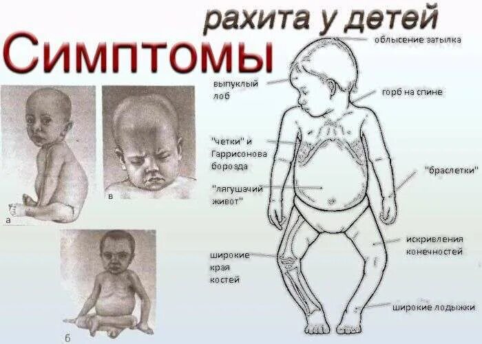 Рахит у детей симптомы до года фото Рахит у грудничков (детей до года): признаки и симптомы рахита, лечение, профила