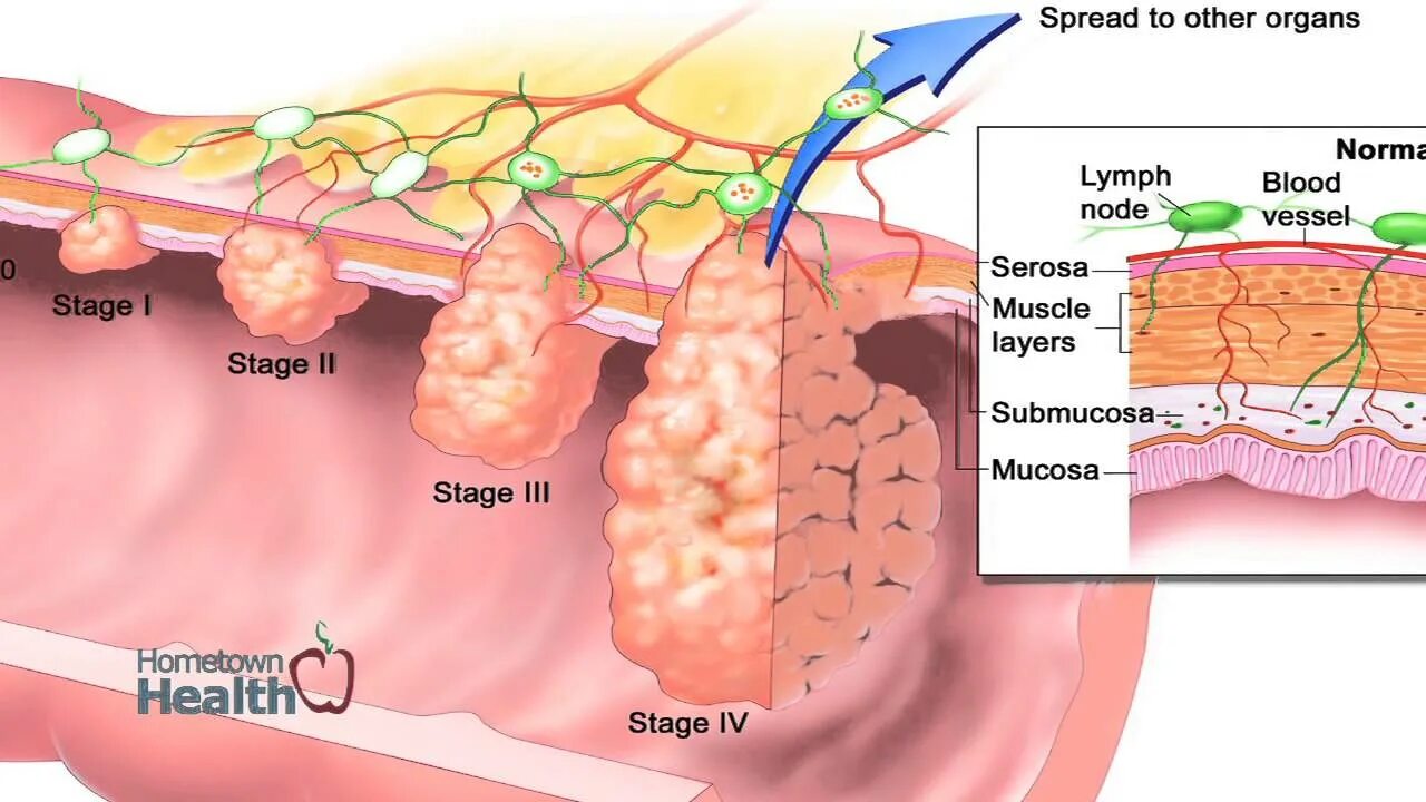 Рак 3 стадии фото Advanced Gastroenterology and Surgery Associates - Colon Cancer Screening - YouT