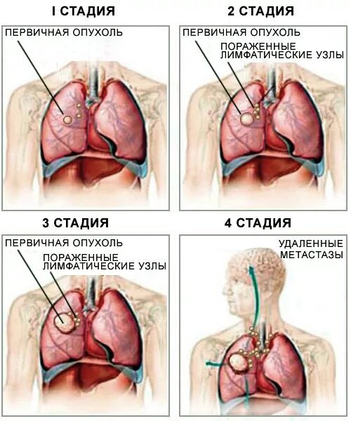 Рак 3 стадии фото Симптомы рака: как распознать онкологию на ранних стадиях