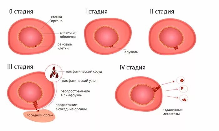 Рак 3 стадии фото Стадии рака: какие бывают и как определяются, как быстро развивается рак, класси