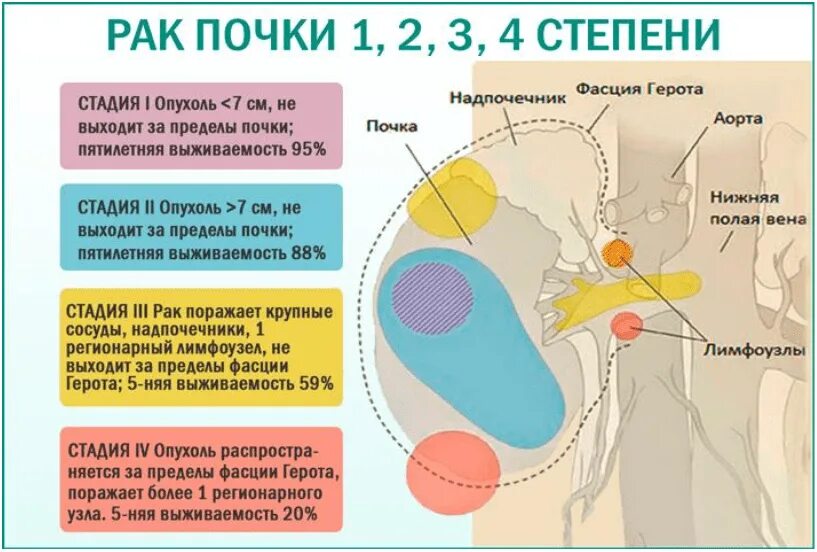 Рак 4 стадии фото Злокачественные опухоли почек.