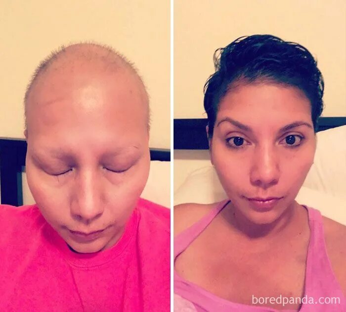 Рак 4 стадии фото людей People Who Beat Cancer In Powerful Before & After Pictures