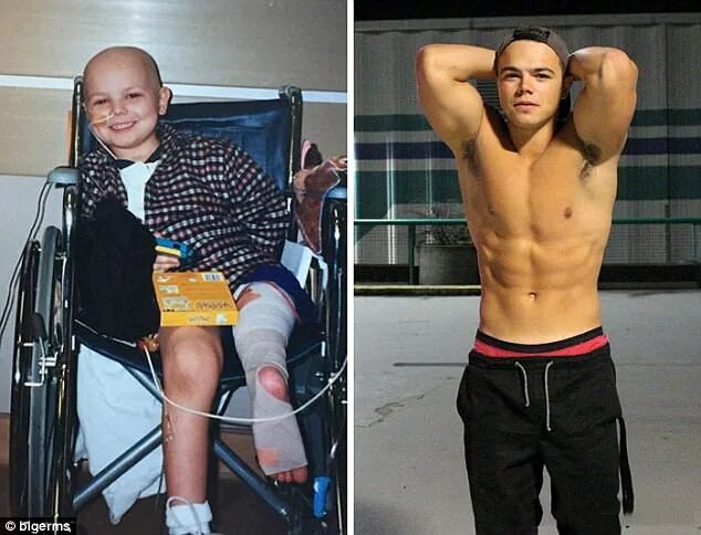 Рак 4 стадии фото людей Cancer survivors post transformation photos on Bored Panda