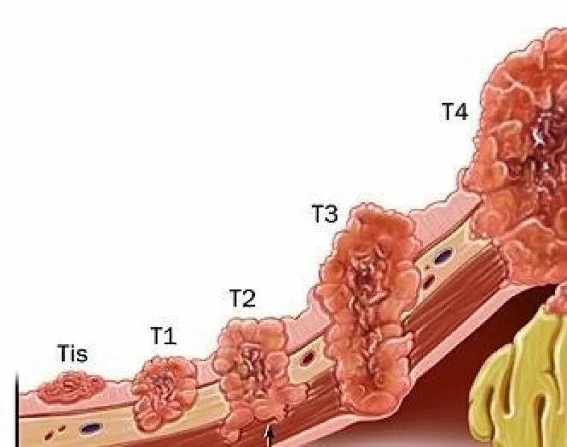 Рак 4 стадии фото людей Рак предстательной железы: коротко о важном Prostate Center Europe