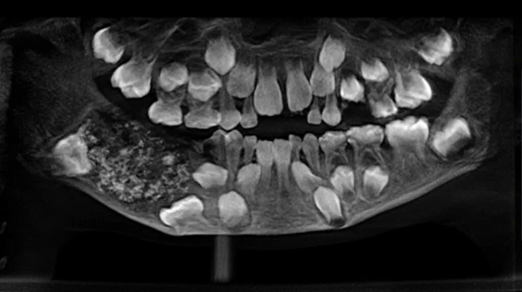 Рак челюсти у человека симптомы лечение фото Doctors remove 526 'tooth-like structures' from 7-year-old boy's mouth