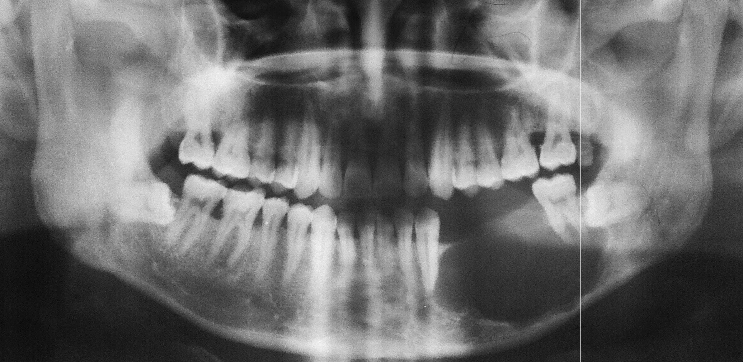 Рак челюсти у человека симптомы лечение фото Image Radiopaedia.org