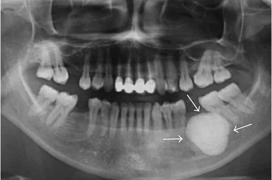 Рак челюсти у человека симптомы лечение фото Figure 3 from Large Peripheral Osteoma of the Mandible: A Case Report Semantic S