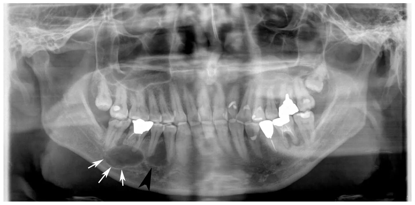 Рак челюсти у человека симптомы лечение фото Simultaneous occurrence of keratocystic odontogenic tumor and ameloblastoma in t