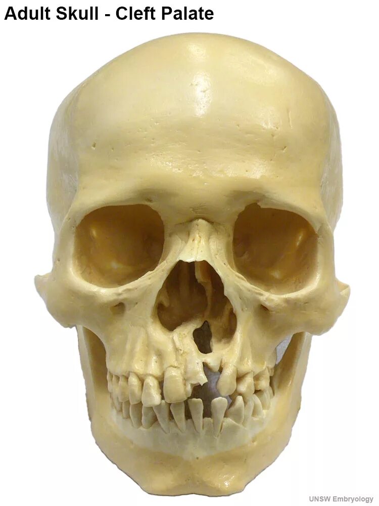 Рак черепа фото File:Adult skull cleft palate 01.jpg - Embryology