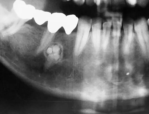 Рак десны фото начальной стадии Odontoma: the benign tumor of the teeth, how to intervene and heal