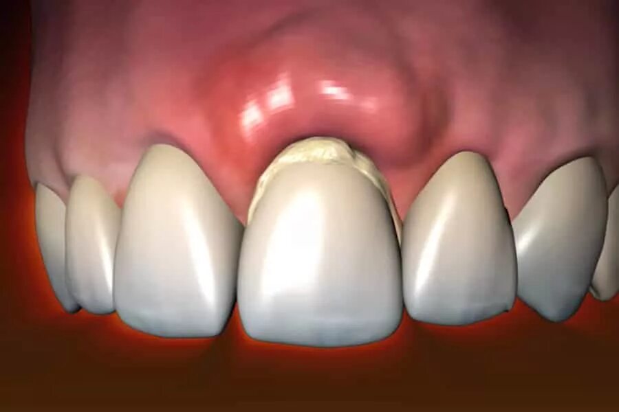 Рак десны фото начальной стадии как выглядит Шишка на десне после установки импланта - Полезные статьи на сайте стоматологиче