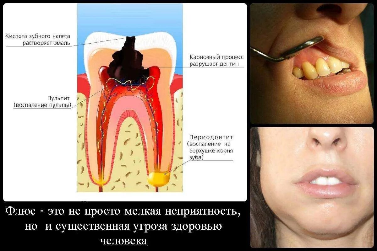 Рак десны симптомы фото признаки Периодонтит зуба: цена лечения от 9 000 ₽ в Москве от стоматологии Дио Дент