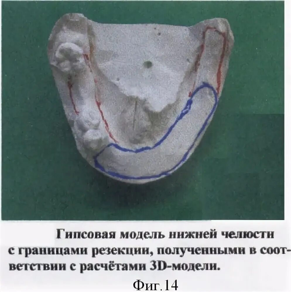 Рак дна полости рта фото начальная стадия Иллюстрации к патенту 2371141 - Способ функциональной реабилитации больных, пере