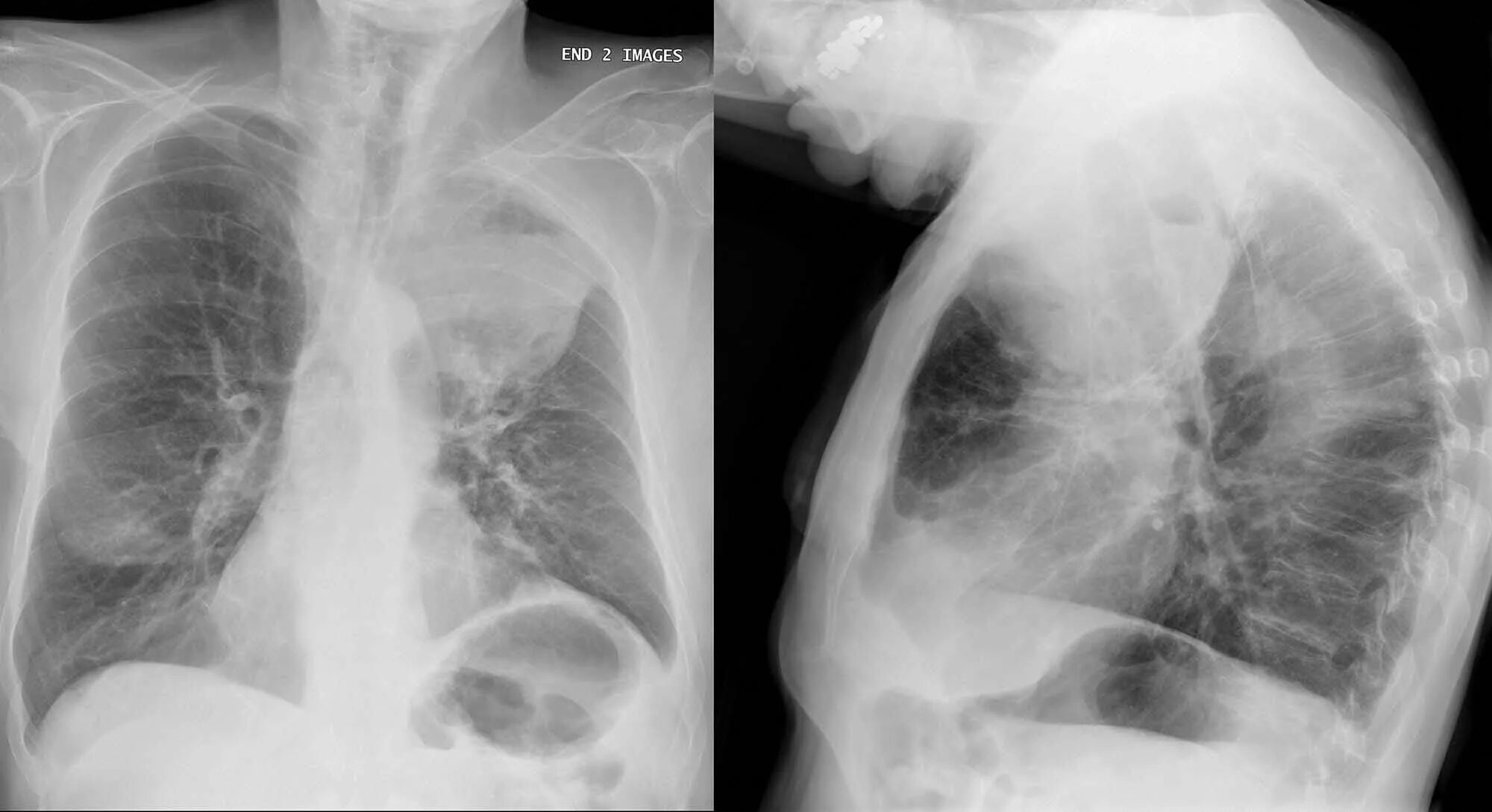 Рак фото начальная стадия фото Adjuvant Osimertinib: A New Standard in EGFR-Mutant NSCLC- Cancer Therapy Adviso