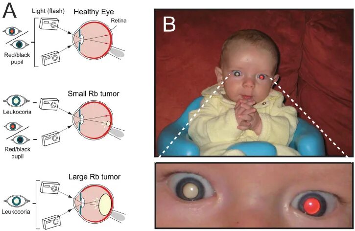 Рак глаза фото Leukocoria in Children with Retinoblastoma. A ) The reflection of... Download Sc