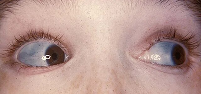 Рак глазного яблока фото File:Characteristically blue sclerae of patient with osteogenesis imperfecta.jpg