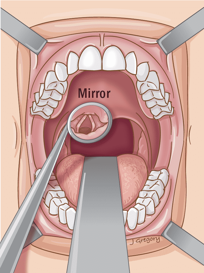 Рак глотки первая стадия фото What is Endoscopy * Cancer Basics * THANC Guide