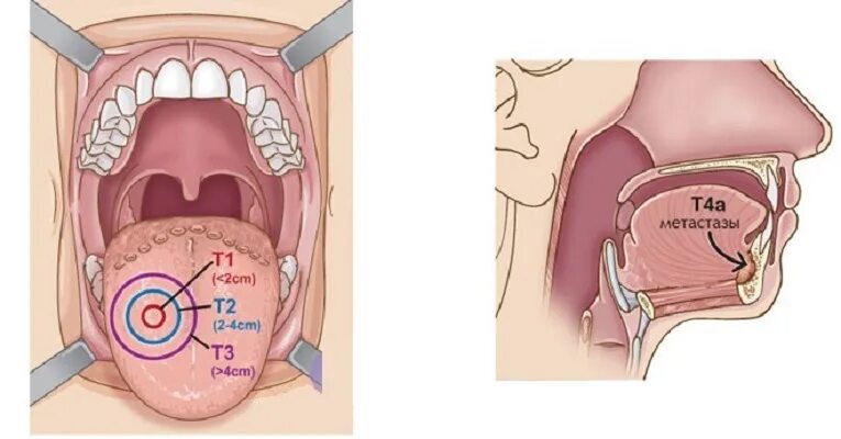 Рак горла фото и описание Лечение рака полости рта в клинике OncoCareClinic 308