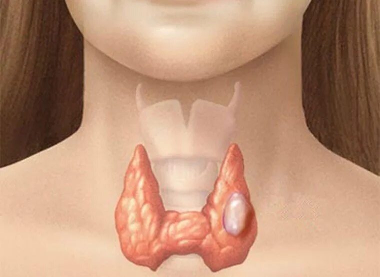 Рак горла фото шеи Thyroid cancer causes and symptoms Vinmec