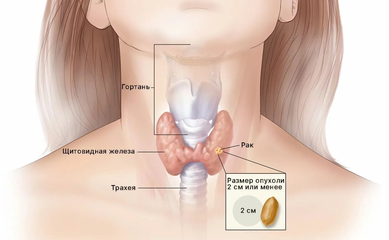 Рак горла фото шеи Рак щитовидной железы: причины, симптомы, стадии, выживаемость