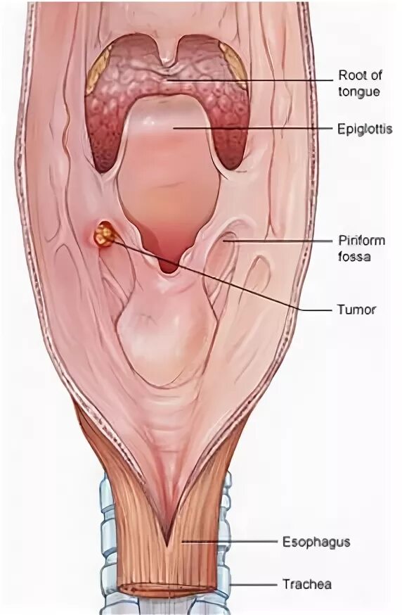 Рак горла фото у взрослого Фиброма гортани с картинками