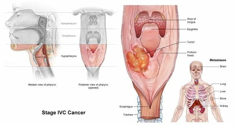 Рак горла последняя стадия фото людей Épinglé sur Head and Neck