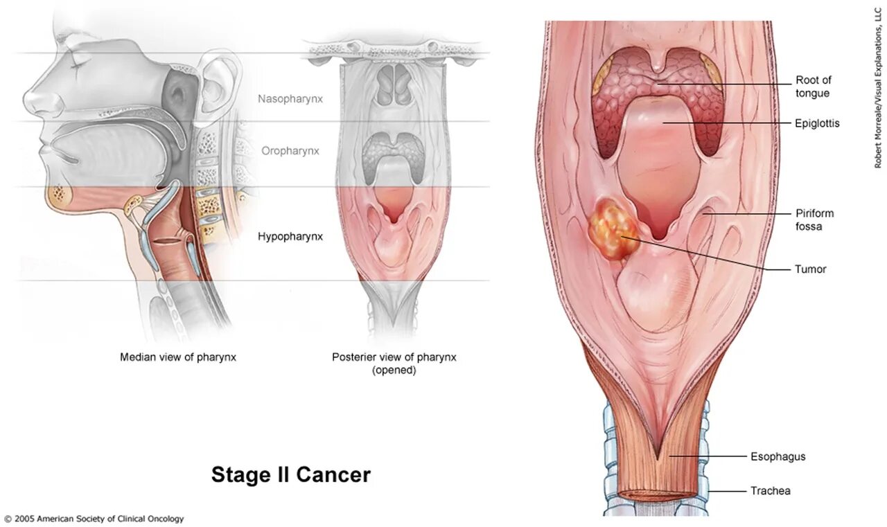 Рак горла сигареты фото Рак ротоглотки по утвержденным клиническим рекомендациям 2020 - найдено 82 фото