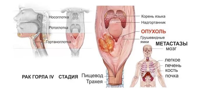 Рак горла симптомы фото первые признаки Последние публикации на сайте " Страница 165 " Информационный медицинский портал