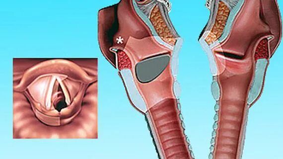 Рак гортани фото начальная стадия симптомы Рака горла и гортани на разных стадиях болезни Foto-Leto.ru