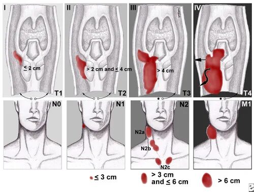 Рак гортани фото последняя стадия Head and Neck Cancer Staging and Guidelines Flashcards Quizlet