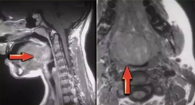 Рак гортани фото стадий МРТ горла и гортани, когда сделать МРТ или КТ гортани, покажет ли МРТ горла пище