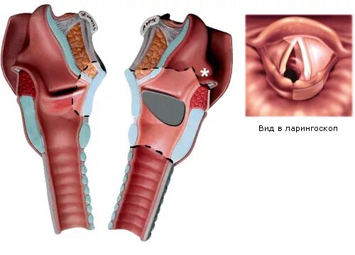 Рак гортани фото стадий Опухоль гортани - Онкология - Болезни - MedClub.ru