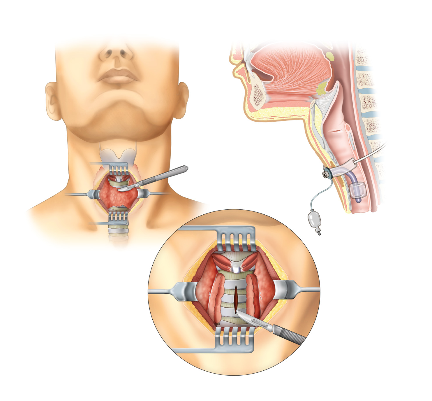 Рак гортани симптомы признаки фото Medical Terminology on emaze