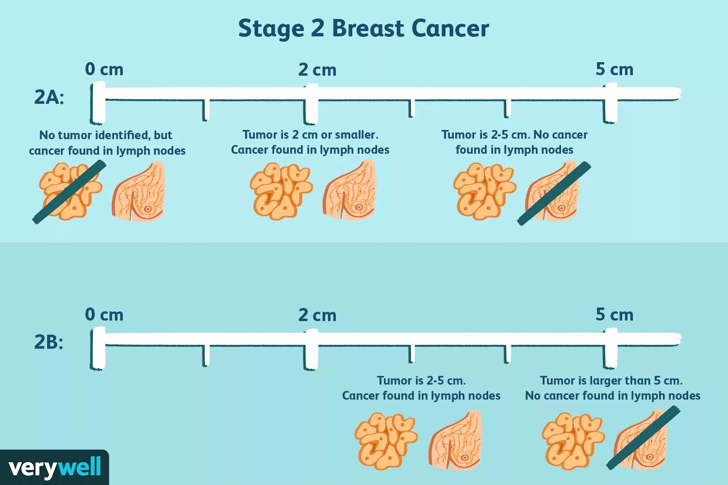 Рак груди 4 стадия фото Dual Plan Phase Breast Enlargement Hotsell xn--h1aahyg1df.xn--p1ai