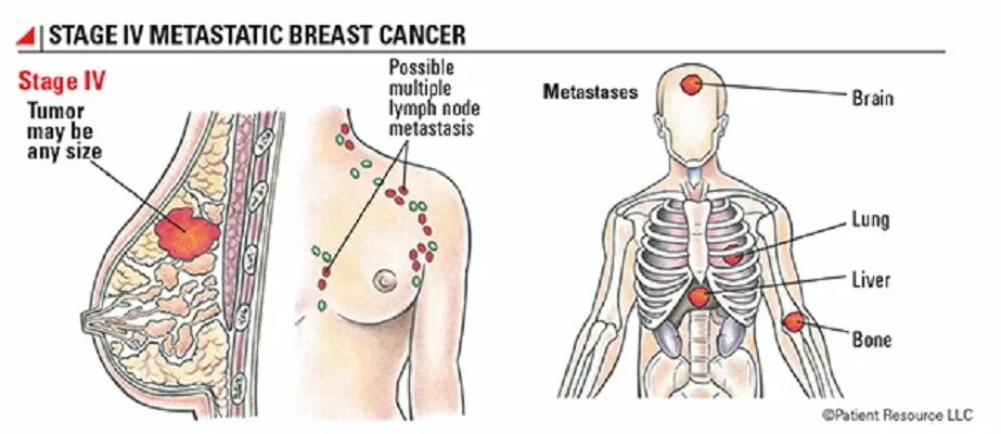 Рак груди 4 стадия фото 12 Essential Facts About Breast Cancer Every Woman Should Know Elite Readers