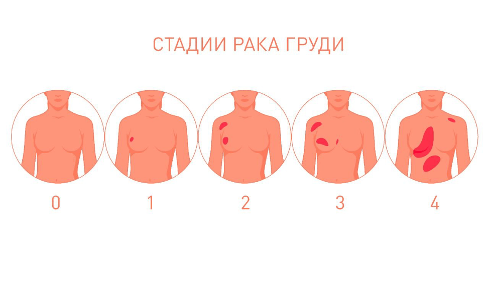 Рак груди 4 стадия фото Как диагностировать рак груди? - Klinik.by