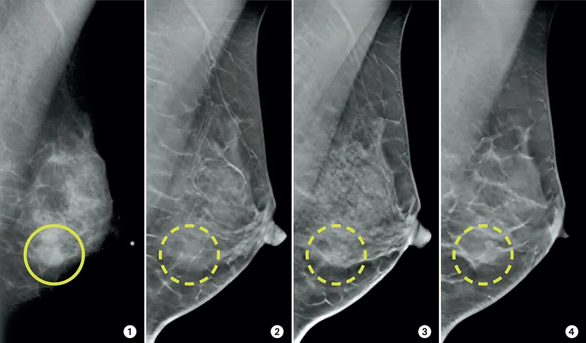 Рак груди 4 стадия фото 3-D mammograms may improve accuracy of breast cancer screening