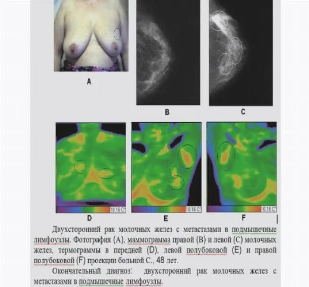 Рак груди 4 стадия фото распад Картинки КАКАЯ БЫВАЕТ ОПУХОЛЬ МОЛОЧНОЙ ЖЕЛЕЗЫ